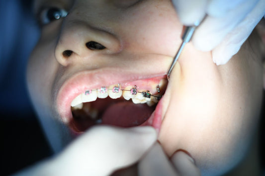 braces being inspected by a dentist